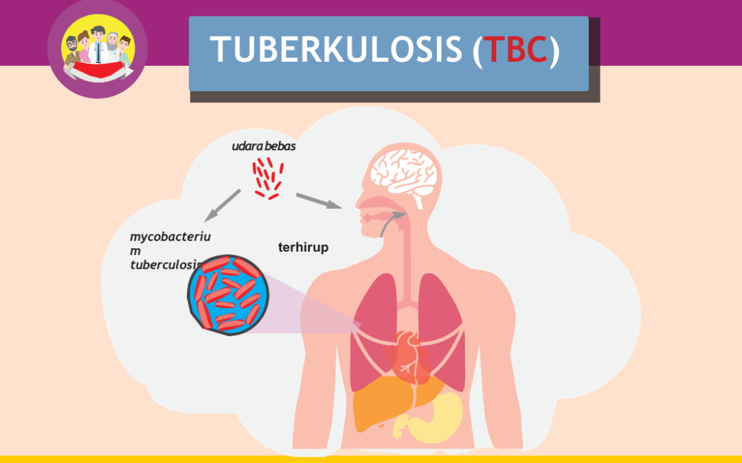 Informasi Dasar Seputar TBC